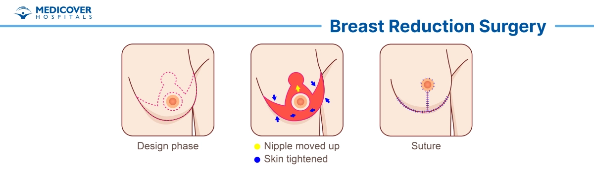 Breast Reduction Surgery