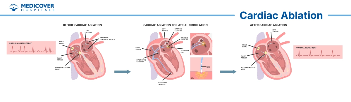 Cardiac ablation