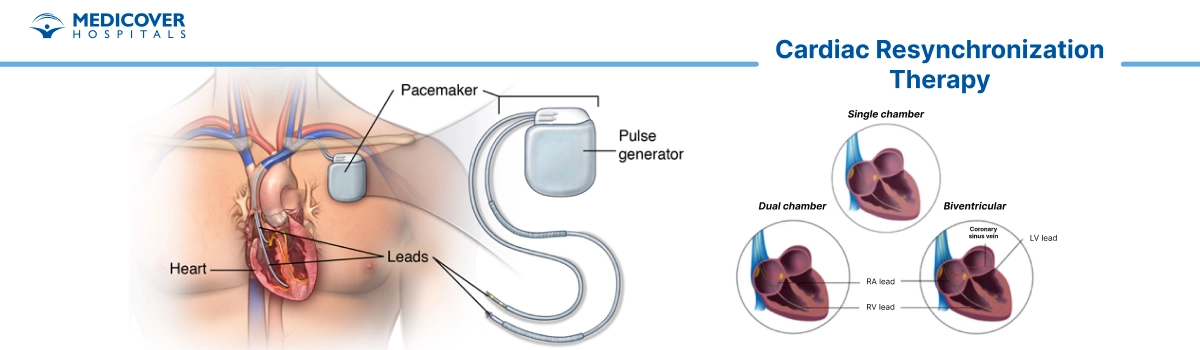 Cardiac resynchronization therapy