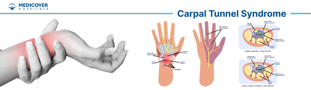 Carpal tunnel release
