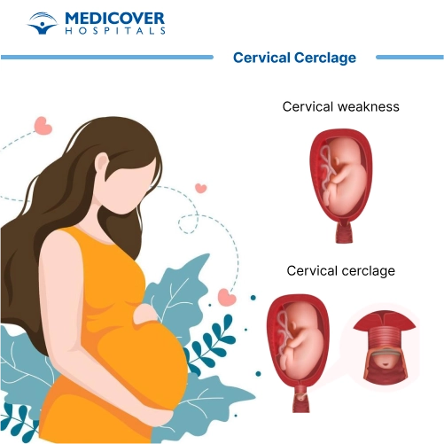 Cervical cerclage