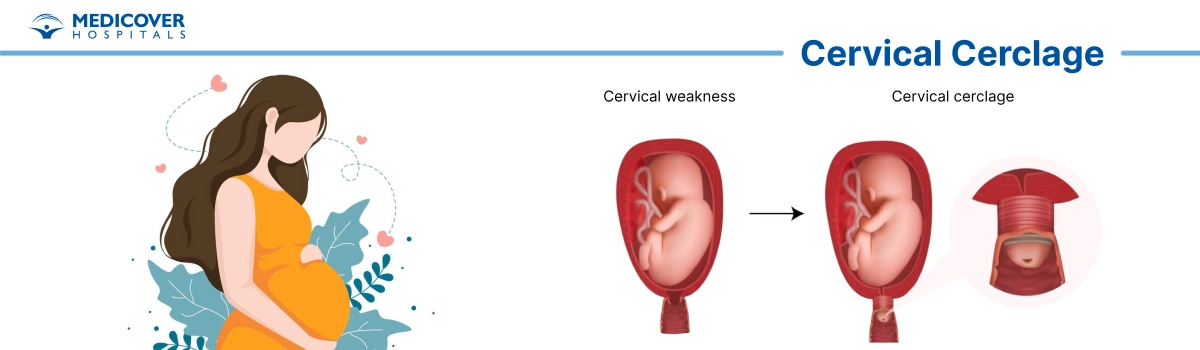 Cervical cerclage