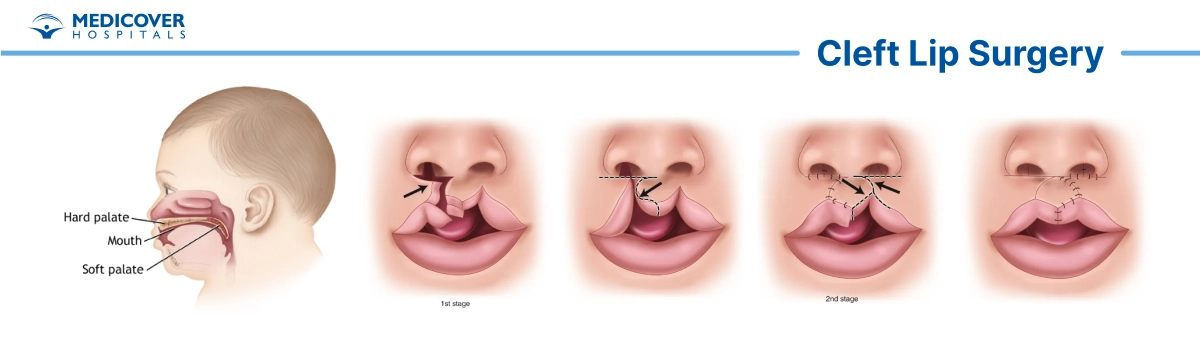 Cleft lip surgery