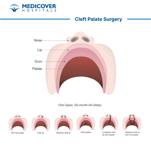 Cleft palate surgery