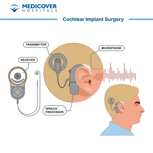 Cochlear implant