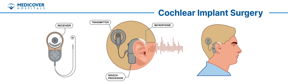 Cochlear implant