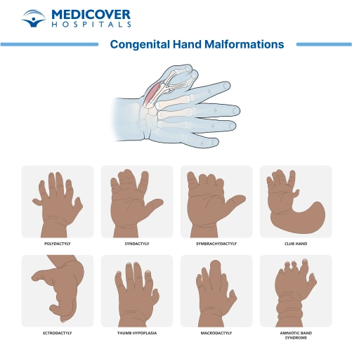 Congenital Hand Malformations Surgery