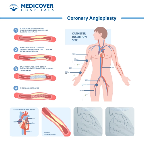 Coronary Angioplasty and Stents Insertion