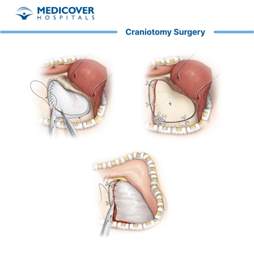 Craniotomy