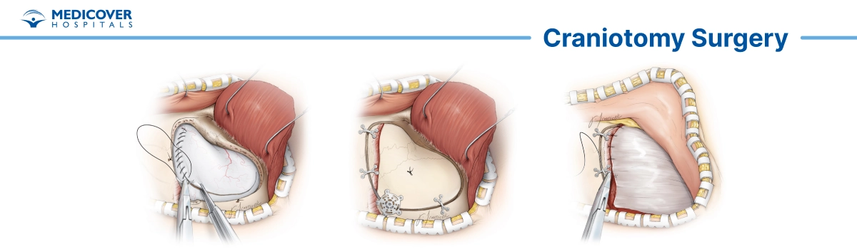 Craniotomy