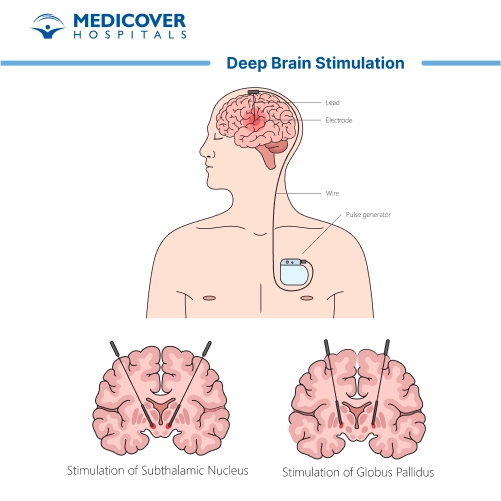 Deep Brain Stimulation