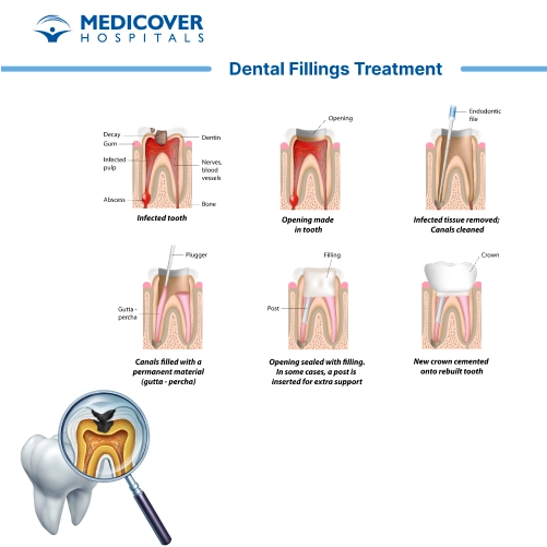 Dental Filling