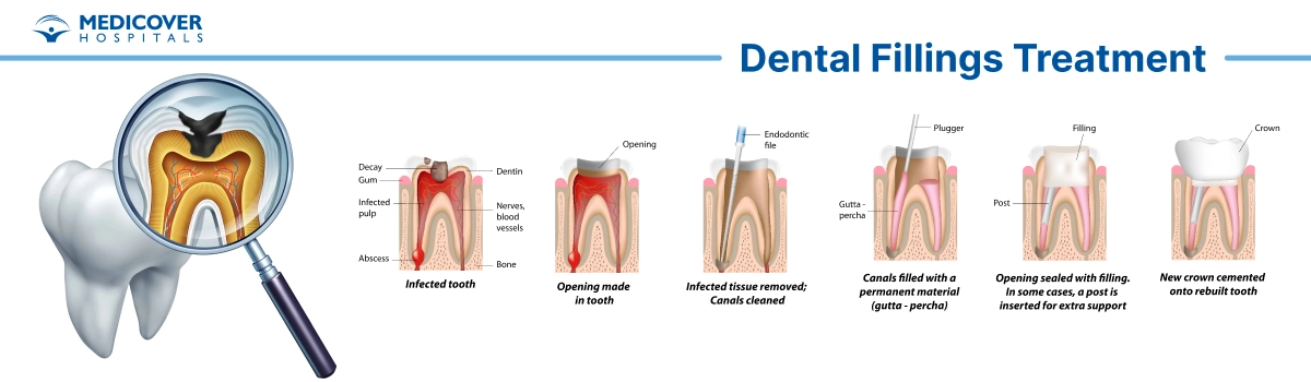 Dental Filling