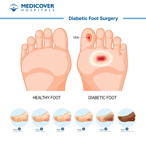 Diabetic Foot Surgery