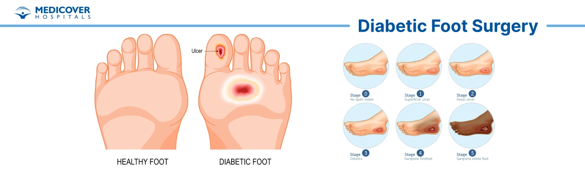 Diabetic Foot Surgery