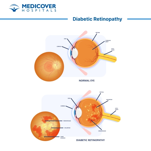 Diabetic Retinopathy