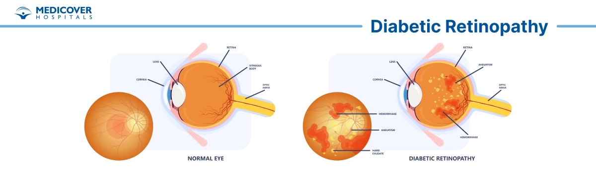 Diabetic Retinopathy