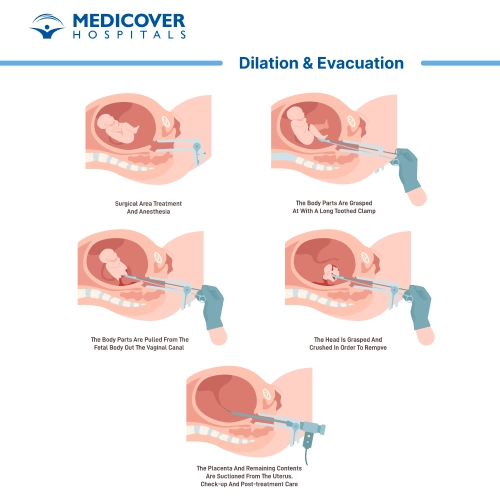 Dilation and Evacuation