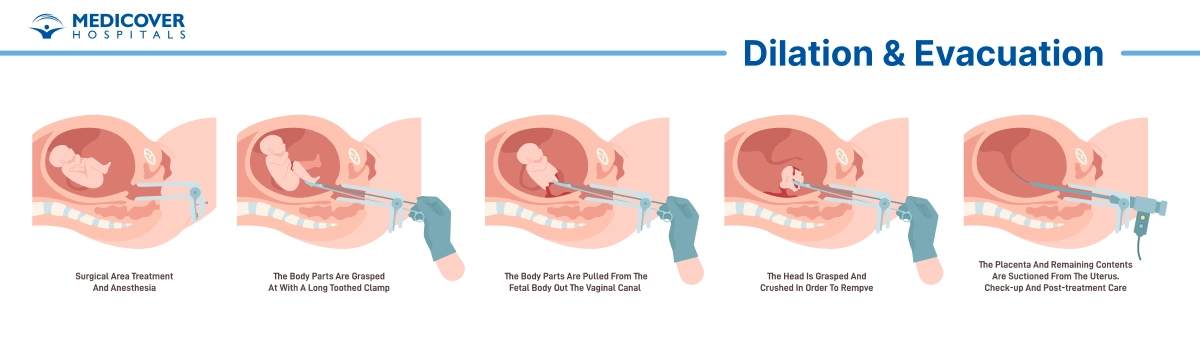Dilation and Evacuation