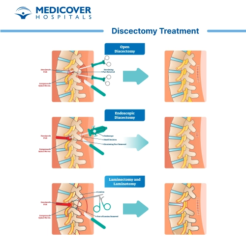 Discectomy