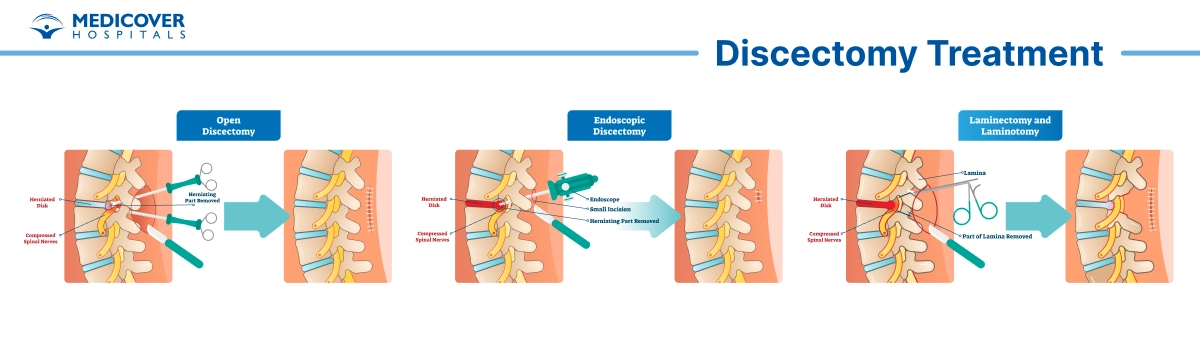 Discectomy