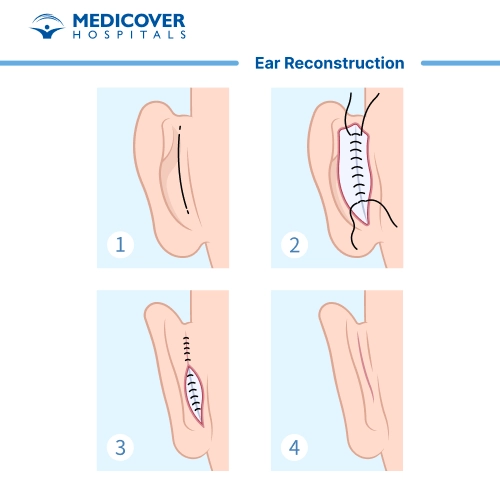 Ear Reconstruction