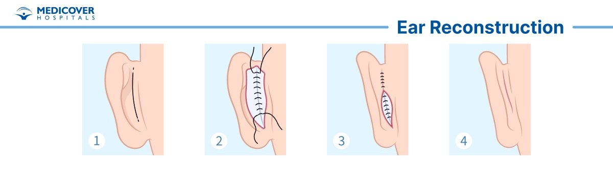 Ear Reconstruction