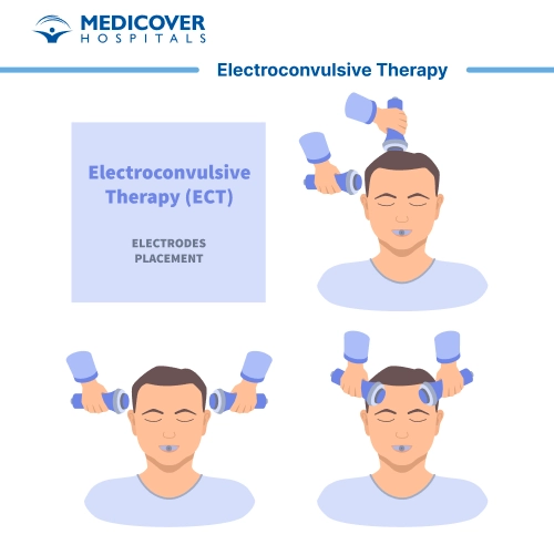 Electroconvulsive Therapy