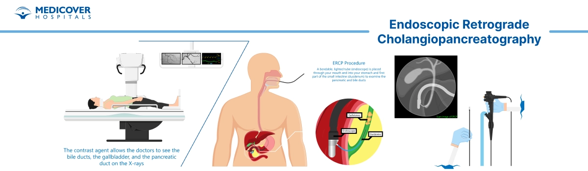 ERCP