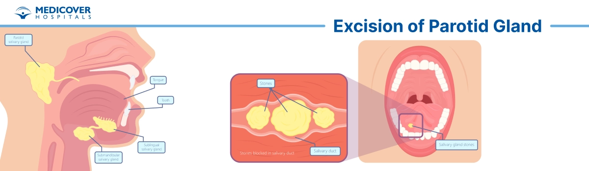 Excision of Parotid Gland