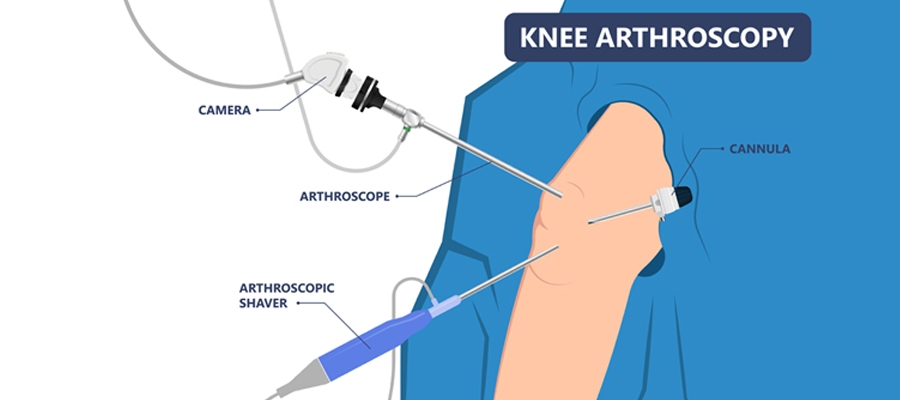 Knee Arthroscopy Knee Arthroscopy