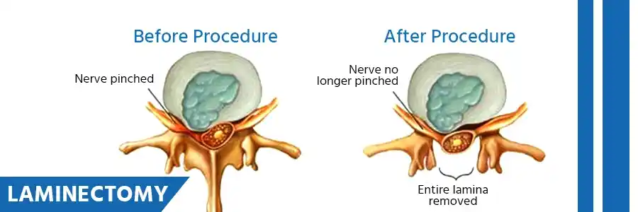 Laminectomy Laminectomy