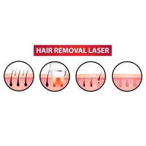 Laser Hair Removal Laser Hair Removal