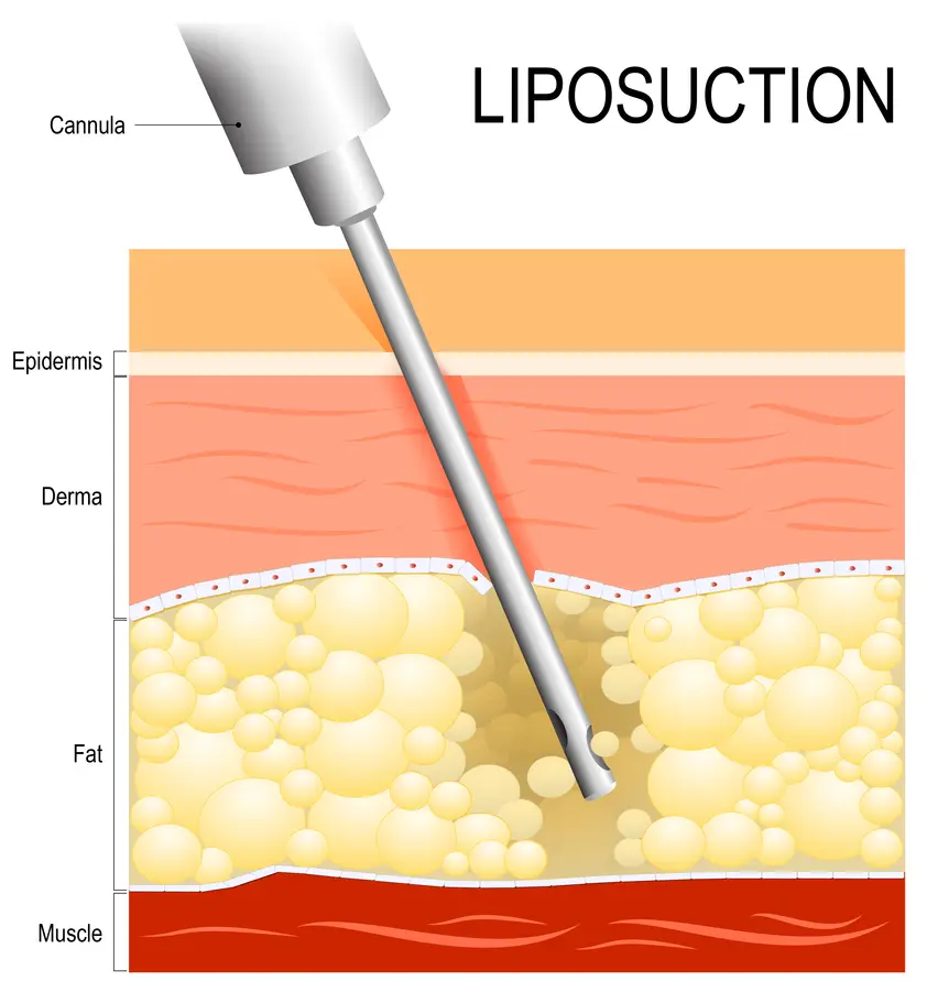 Liposuction Liposuction