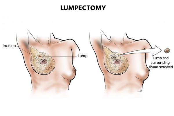 Lumpectomy Lumpectomy