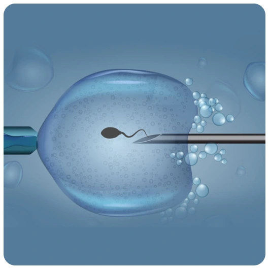 ICSI Treatment