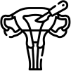 Hysterectomy Image